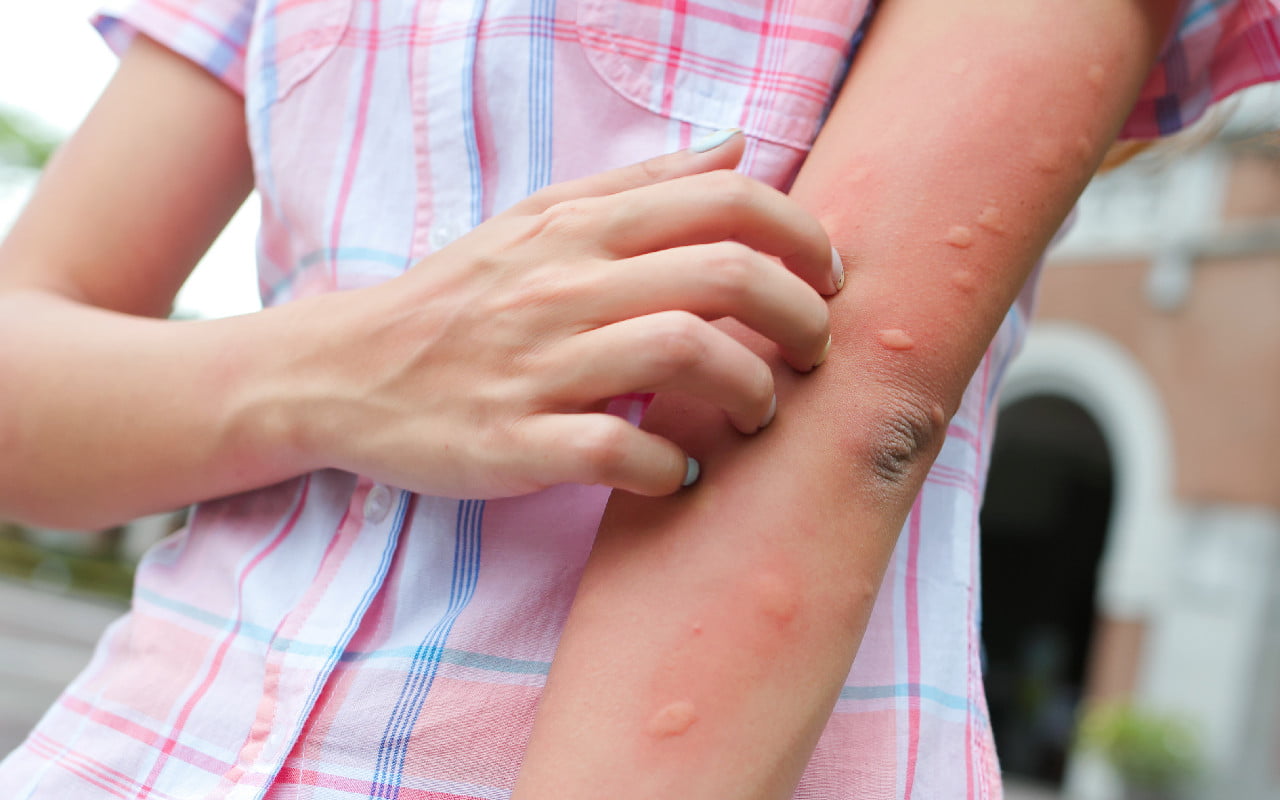 Woman outdoors scratching multiple mosquito bites on her arm.